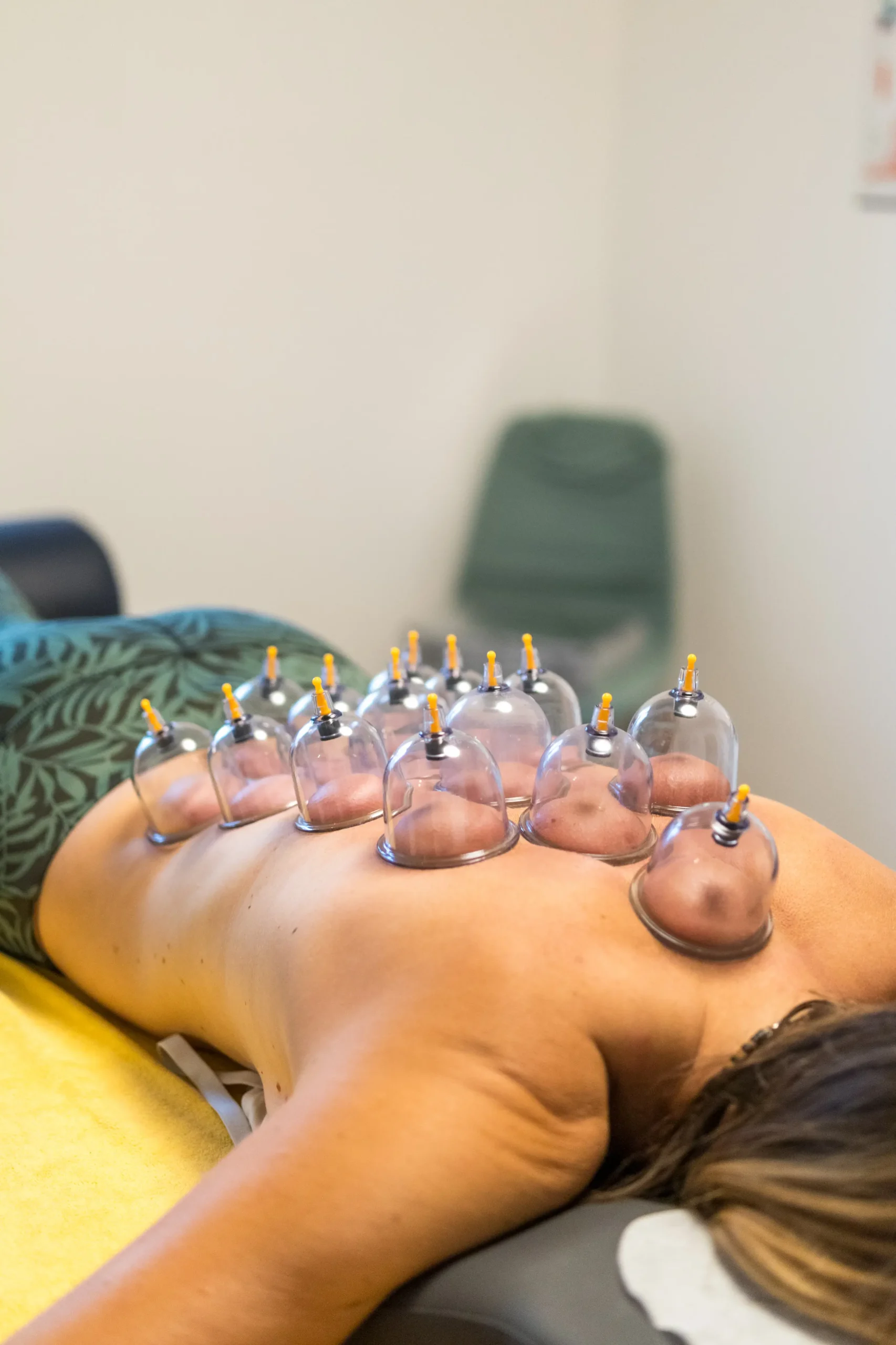 Schröpfgläser am Rücken während sie wirken